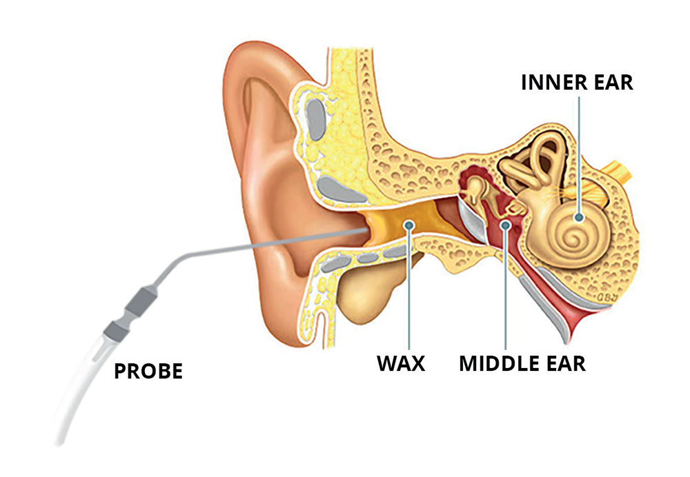 Ear Wax Removal Sharmans Pharmacy